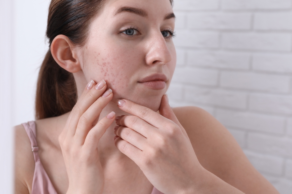 Your Expert-Backed Guide to Laser Resurfacing for Acne Scars in Cambridge, Ohio