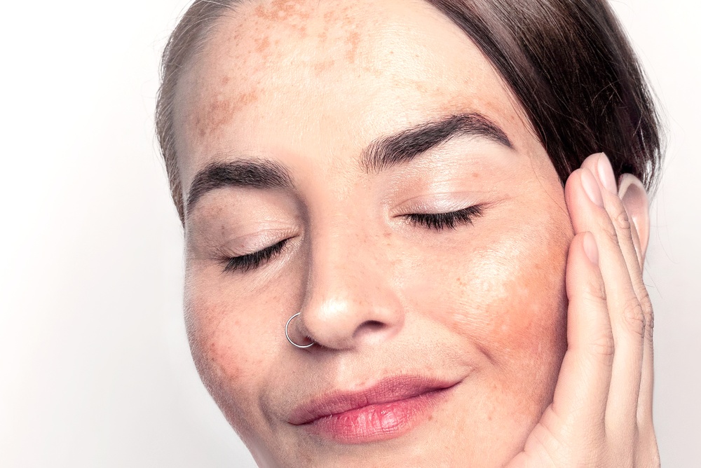 Before and After Laser Resurfacing Treatments for Sun Damage in Sugar Creek, Ohio